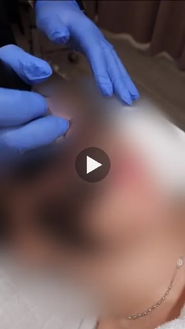 Manos con guantes durante un peeling de carbón activo, con la cara de la clienta difuminada